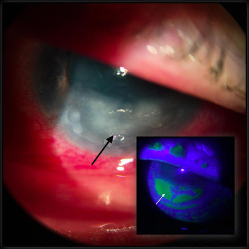 Corneal ulcer - as a result of lagophthalmos